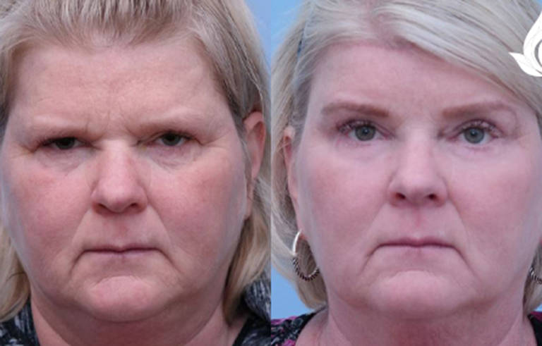 Brow Forehead Lift before and after photo by Midwest Facial Plastic Surgery in Minnesota