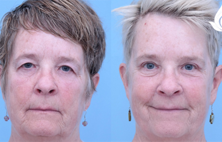 Brow Forehead Lift before and after photo by Midwest Facial Plastic Surgery in Minnesota