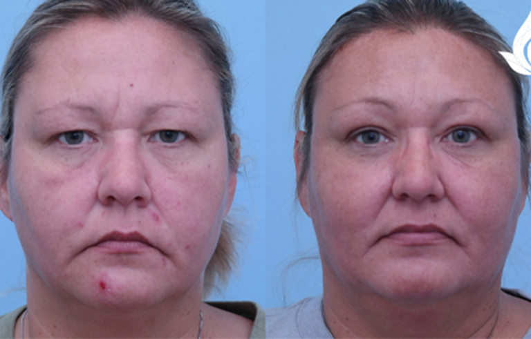 Brow Forehead Lift before and after photo by Midwest Facial Plastic Surgery in Minnesota