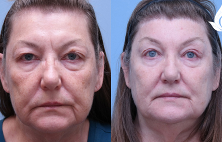 Brow Forehead Lift before and after photo by Midwest Facial Plastic Surgery in Minnesota