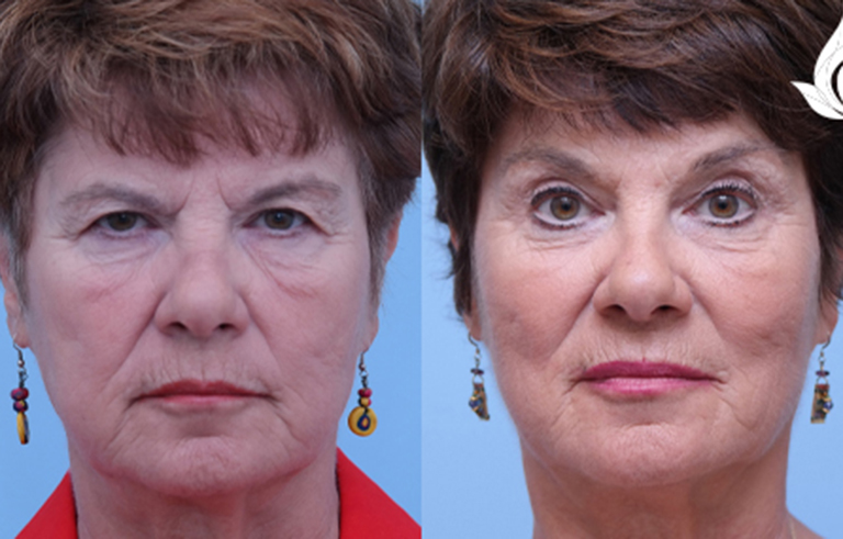 Brow Forehead Lift before and after photo by Midwest Facial Plastic Surgery in Minnesota