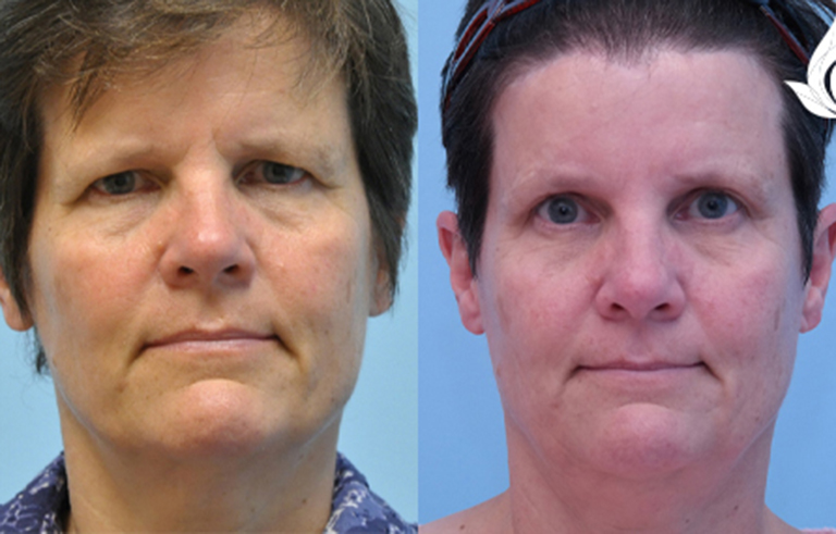 Brow Forehead Lift before and after photo by Midwest Facial Plastic Surgery in Minnesota