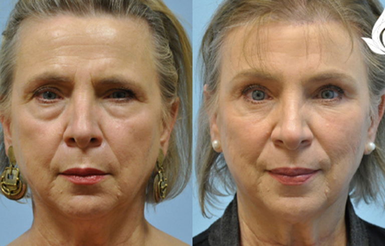 Brow Forehead Lift before and after photo by Midwest Facial Plastic Surgery in Minnesota