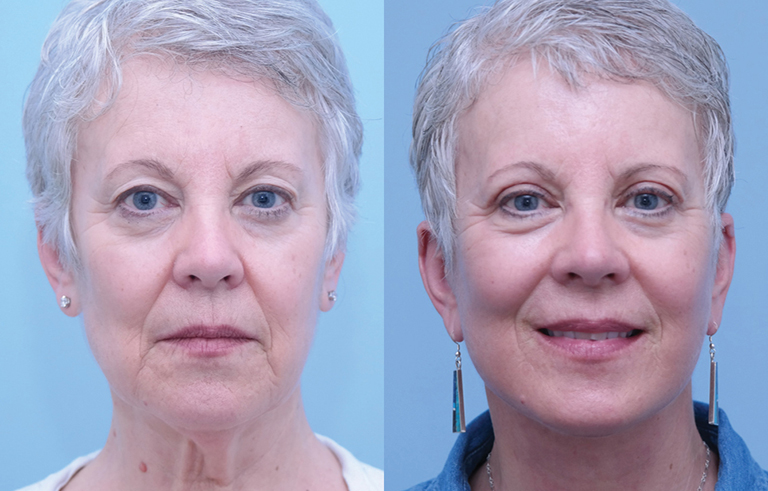 Eyelid Surgery before and after photo by Midwest Facial Plastic Surgery in Minnesota