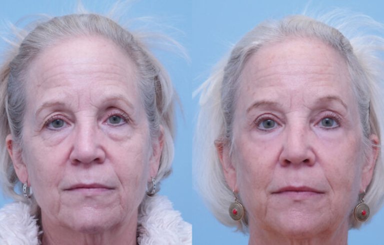 Brow Forehead Lift before and after photo by Midwest Facial Plastic Surgery in Minnesota x