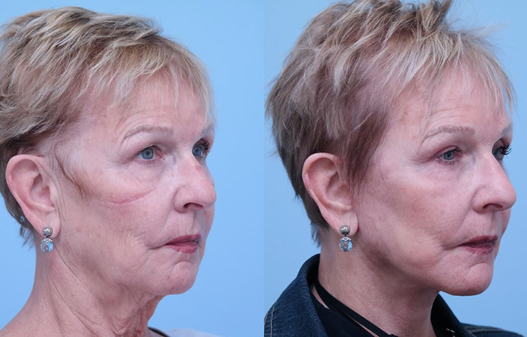 Eyelid Surgery before and after photo by Midwest Facial Plastic Surgery in Minnesota