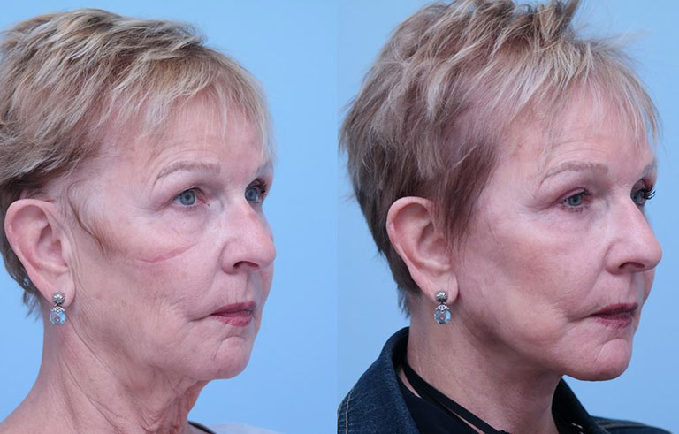 Neck Lift before and after photo by Midwest Facial Plastic Surgery in Minnesota