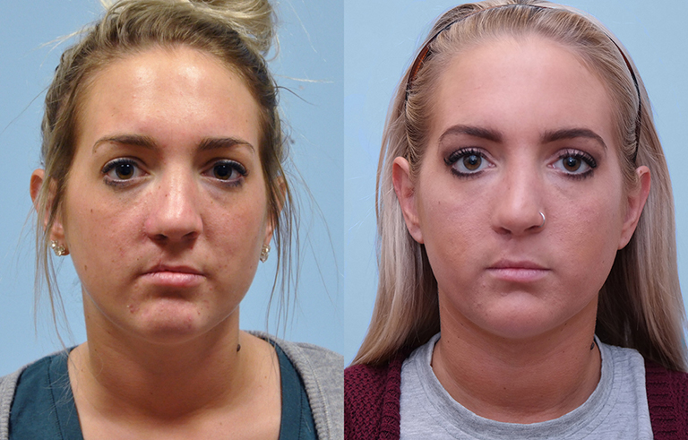 Cleft Lip Nose before and after photo by Midwest Facial Plastic Surgery in Minnesota