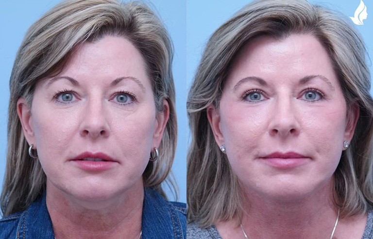 Eyelid Surgery before and after photo by Midwest Facial Plastic Surgery in Minnesota