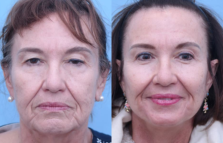 Eyelid Surgery before and after photo by Midwest Facial Plastic Surgery in Minnesota