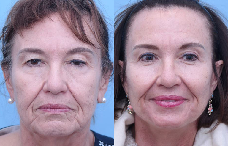 Facelift before and after photo by Midwest Facial Plastic Surgery in Minnesota