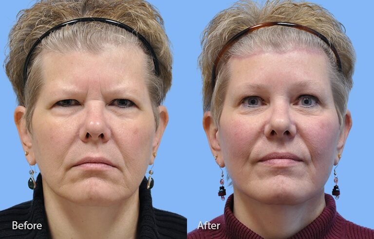 Eyelid Surgery before and after photo by Midwest Facial Plastic Surgery in Minnesota