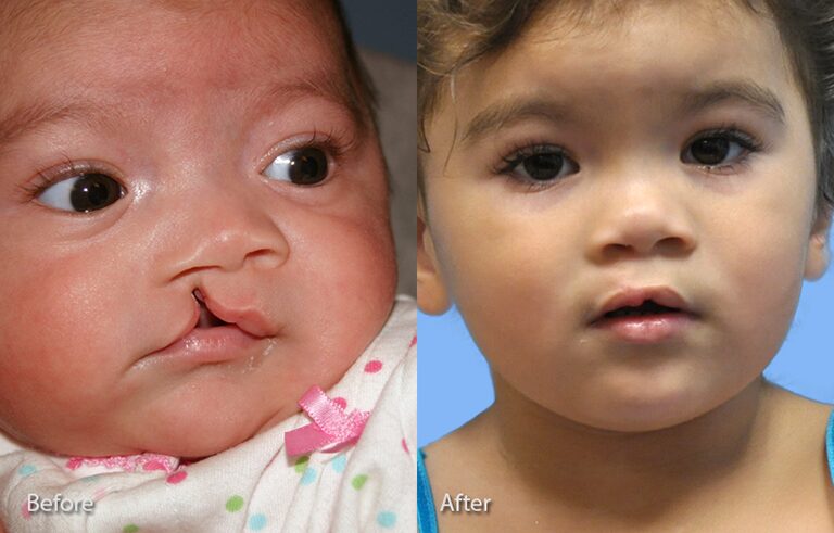 Cleft Lip Nose before and after photo by Midwest Facial Plastic Surgery in Minnesota