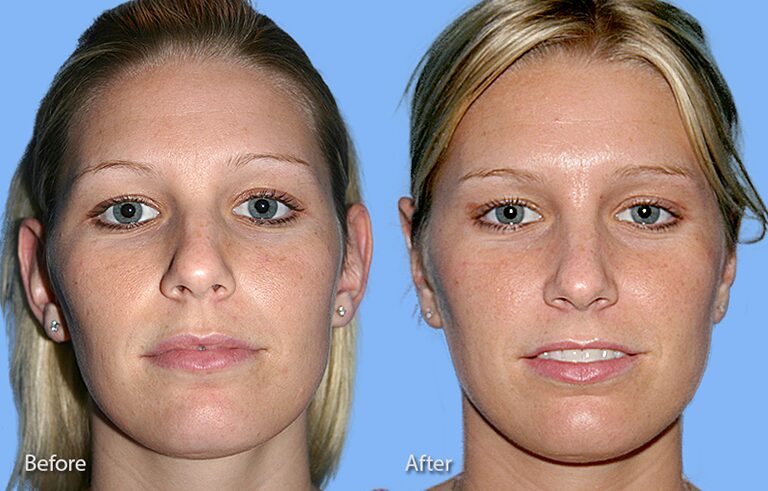 Otoplasty Ear Reconstruction before and after photo by Midwest Facial Plastic Surgery in Minnesota