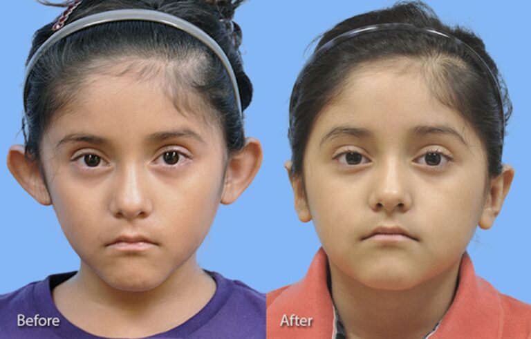 Otoplasty Ear Reconstruction before and after photo by Midwest Facial Plastic Surgery in Minnesota